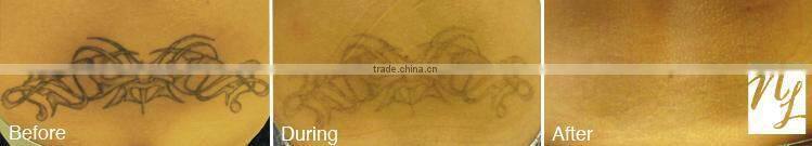 Professional Q-switch ND YAG Laser