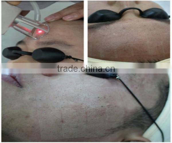 2016 new pixel medical fractional co2 laser acne scar removal machine