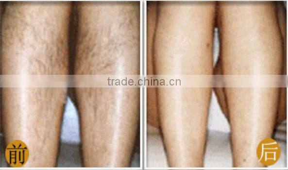 best selling products ipl shr + opt + q switch nd yag laser hair removal machine for sale