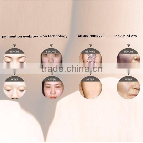 skin cleansing device Q-switched ND YAG laser tattoo removal laser for sale