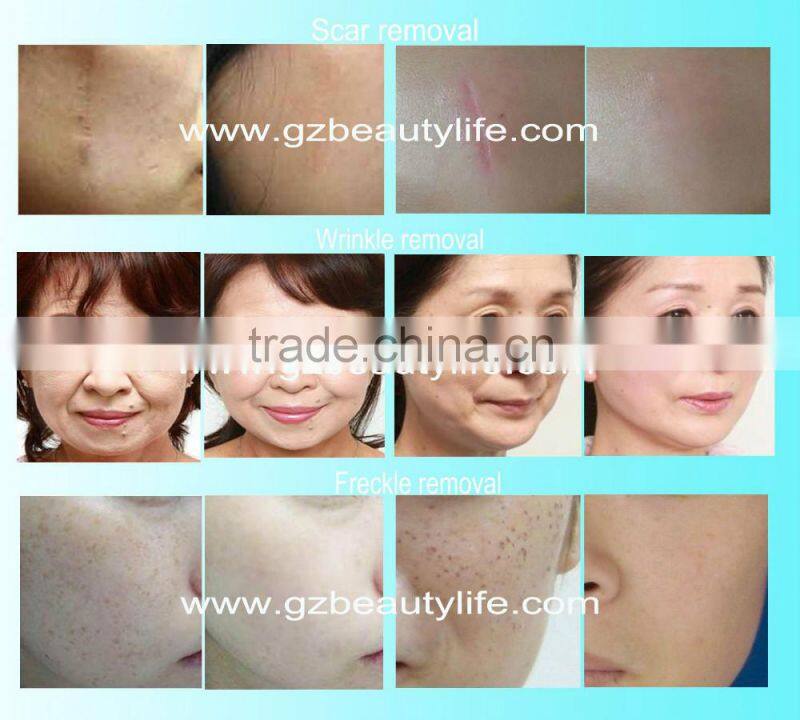 Fractional Laser Co2 Vaginal Tightening Machine