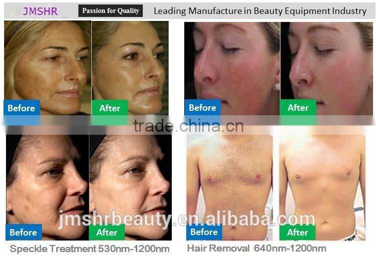 Fast frequency Elight hair reduction ipl device