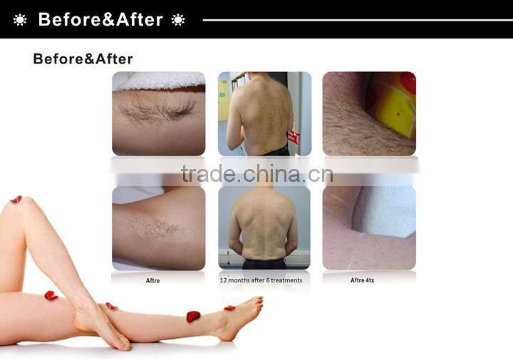 Excellent Result Depilacion Laser Long Pulse Nd Yag Laser LPUSI