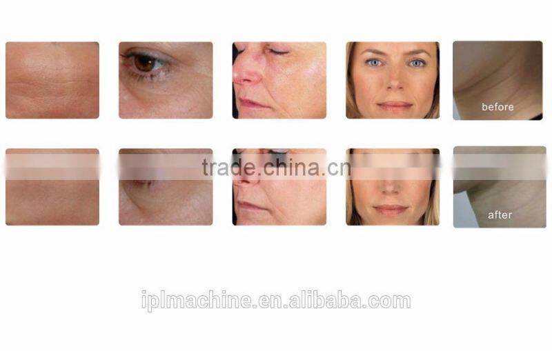 portable pdt beauty equipment