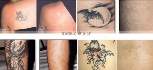 2014 Newest!!! q switched nd yag laser tattoo & pigmentation remova laser l machine with CE for sale!!!