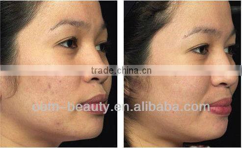 Beauty & Personal Care ipl equipment acne removal