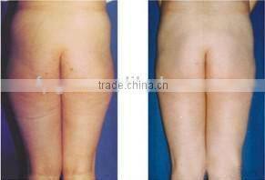 Diode Lipo Laser slimming machine