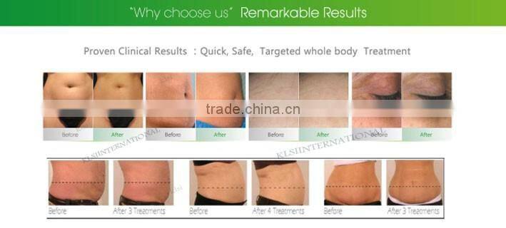 best body slimming machine with cavitation and vacuum