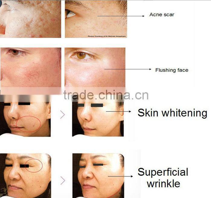 Portable fractional rf microneedle machine for skin fractional rf thermolysis device