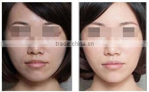 2014 super Cooling systern Nd Yag Laser Hair Removal / Long Pulse Laser Hair Remover MachinesP003