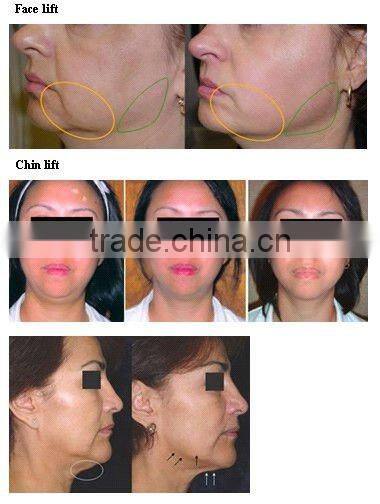 Stationary RF (radiofrequency)Beauty Machine For Skin Lift B004