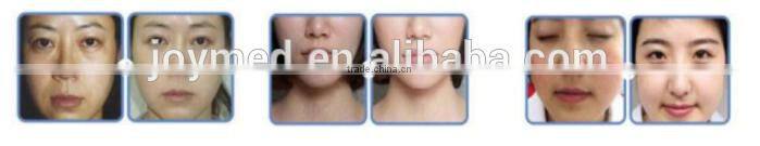 IPL Hair Removal Salon Equipment CE approve