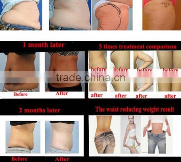 fast cavitation slimming system
