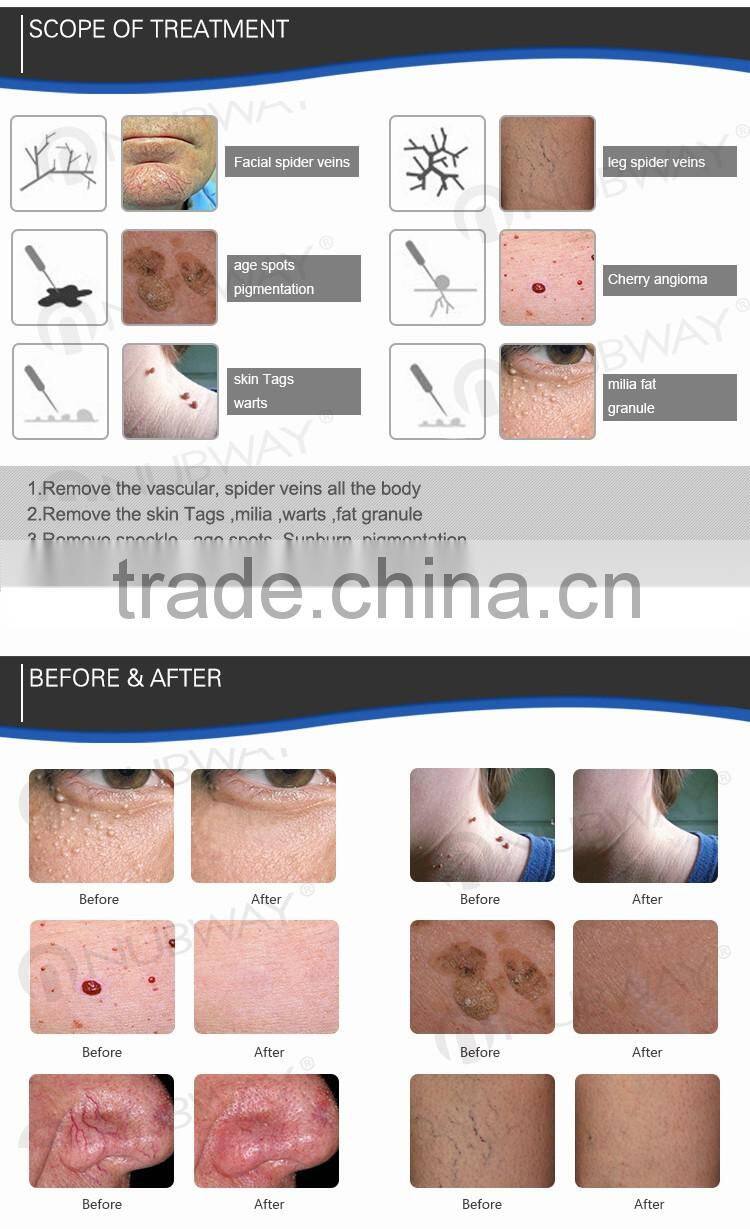 2016 Special promotion !!! High frequency thermocoagulation spider vein removal machine