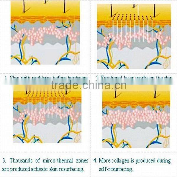 laser rf tube CO2 fractional physiotherapy laser