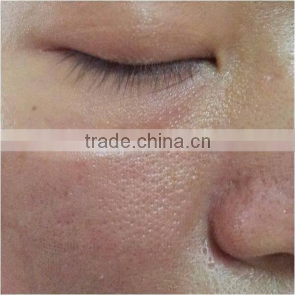 acne scar removal laser CO2 Laser Resurfacing Machine high quality and best price fractional c02 laser from popipl