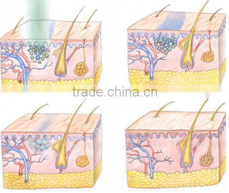 q switched nd yag laser , 532nm 1064nm Tattoo removal and black spot removal machine