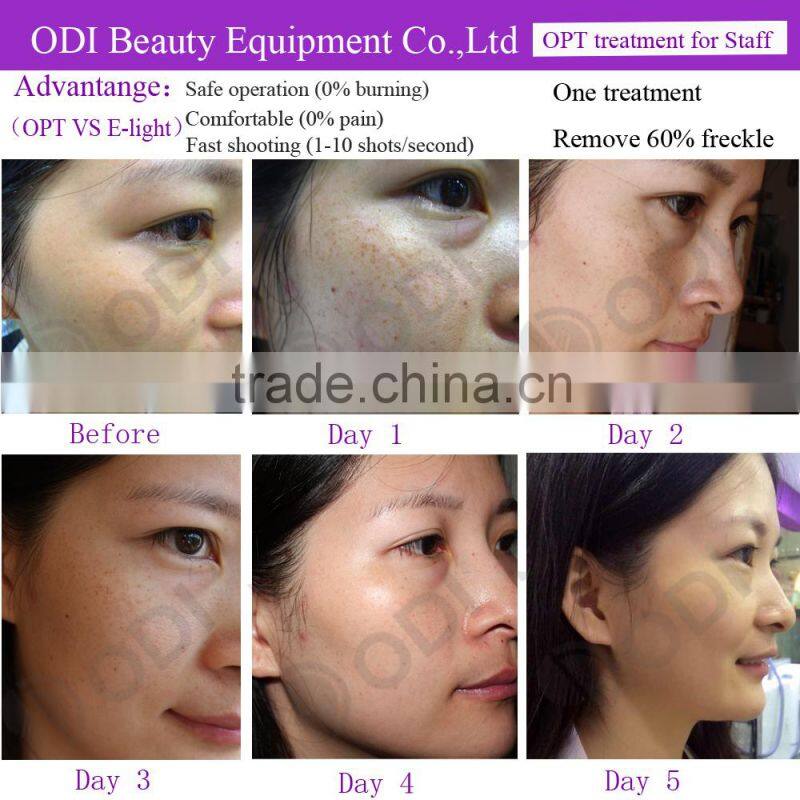 Optimal Pulse Technology OPT Multi-functional shr best professional ipl machine for beauty salon equipment shr ipl hair removal