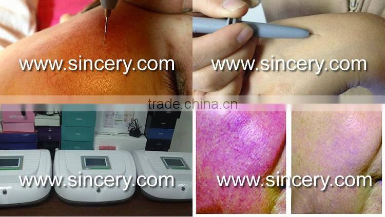 Clinical Laser RBS Vascular Veins Spider Vein Removal Device for Skin Disorder Treatment