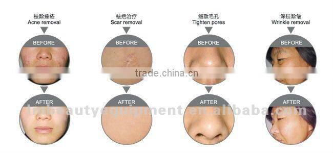 hot sell skin dialysis machine