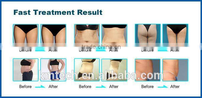 Maufacturer of Lipo Cavitation Body Slimming Equipment Used at City SPA