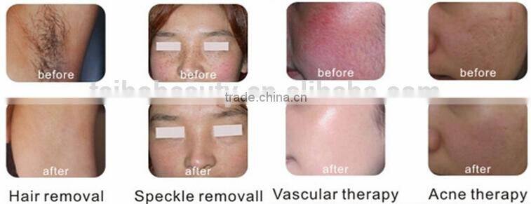 wholesale beauty supply E-light+ RF+ nd yag laser machine looking for distributors