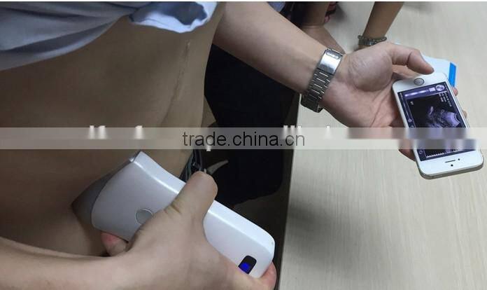 Wireless Convex Probe Scanner, WiFi, Used in Surgery Without Fixing of Cables, 3.5MHz / R40 / 64 Elements, SIFULTRAS-5.1