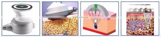 Ultrashape's unique pulsed for Ultrashape Slimming Machine/ Hifu Slimming Machine OEM/ODM