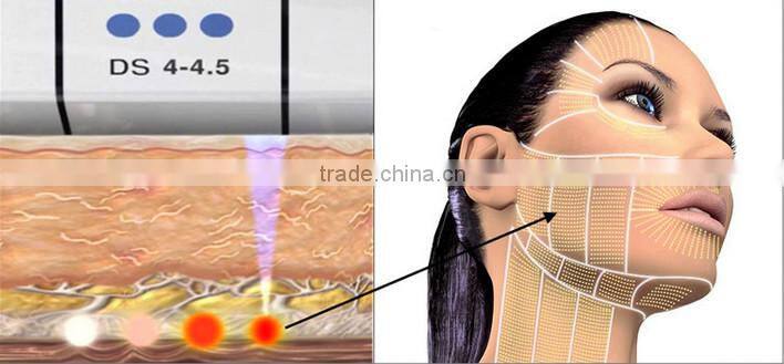 Hot sale neck treatments for sagging skin hifu system machine for anti aging anti wrinkle
