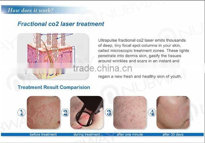 30W RF Mental Tube CO2 Laser Fractional Acne Scar Removal Machine