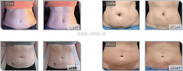fat freezing liposuction cryolipolysis freeze sculptor freeze fat to lose weight