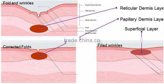 Personal care and beauty series product fractional rf skin lifting machine