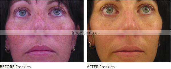 big spot size fast hair removal ipl beauty equipment for sale