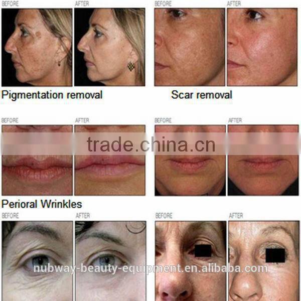 Top quality & best selling!!! laser vaginal rejuvenation laser co2 fractional co2 laser with CE