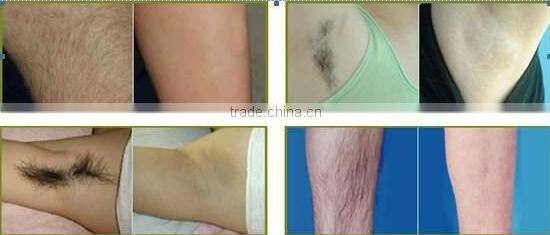 Home Use Portable Laser Hair Removal System Device 808nm Laser Diode