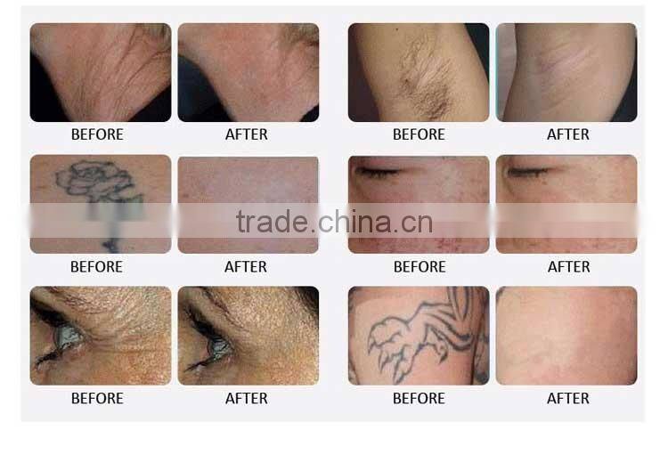 Merry Christmas biggest discount! Yes ipl shr Q-Switch Hair Removal Tattoo Removal Whitening Feature multifunctional machine