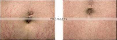 beauty studio acne scars treatment body dermaroller 1080 needles -L008