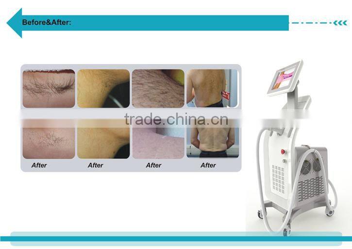 Diode Laser 808nm Machine Hair Removal