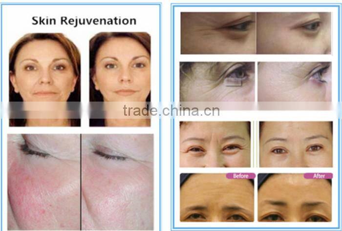 ipl laser hair removel machine for sale