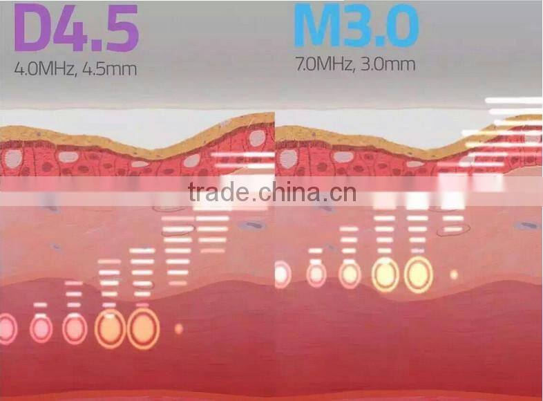 2016 new product Portable Hifu skin care vaginal tightening Sexy beauty machine