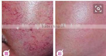 2016 High Frequency Vascular laser vein remove/ 980nm spider vascular remove