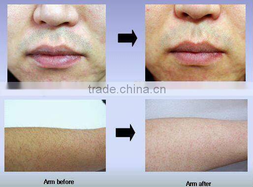 2014 808nm/810nm skin rejuvenation /hair removal laser soprano