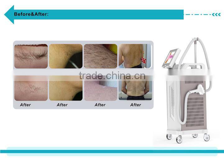 808nm diode laser non channel diode laser