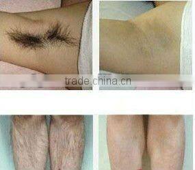 nd yag laser tattoo remover