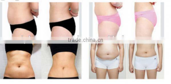 HIFU body shaping machine for weight loss centre