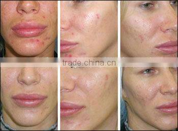 best pride for 200 needles derma roller with replacable head for skin cure