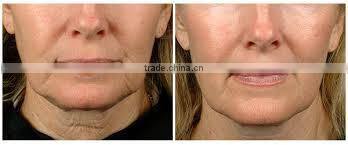 New designed skin tightening vacuum cavitation rf/multipolar vacuum rf