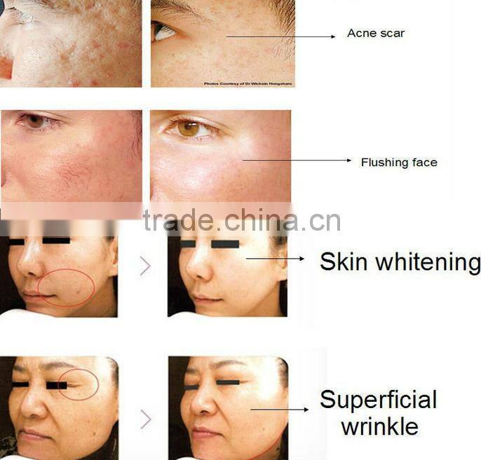Skin Tightening Fraction Radio Frequency portable rf facial treatment face lifting machine
