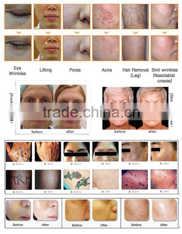 2 size handles !! IPL Hair Removal Wrinkle Removal E-light Technology RF Machine