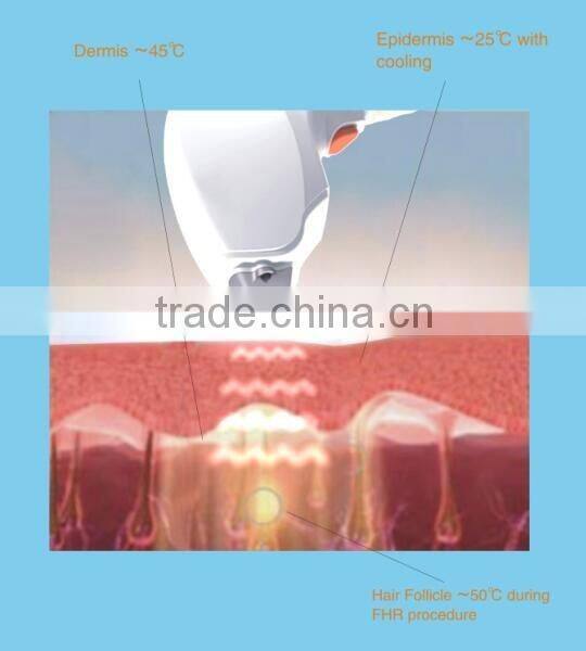 New depilation products laser hair removal /808nm diode laser hair removal /laser hair removal machine price